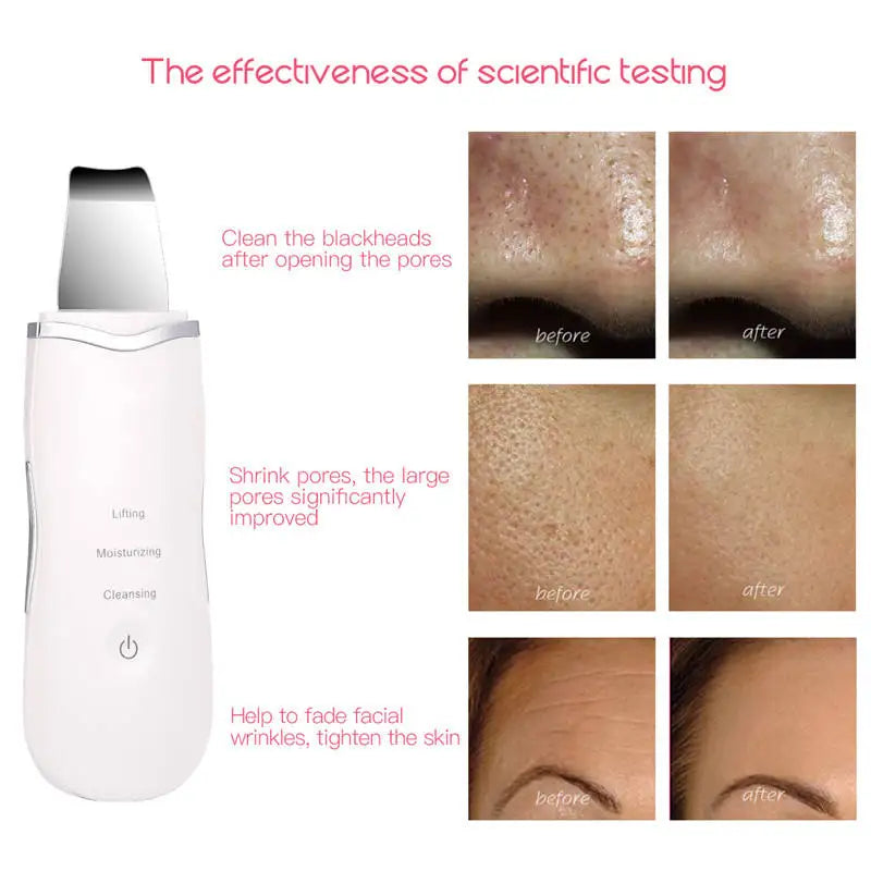 3-in-1 Ultrasonic Facial Skin Scrubber and Pore Cleaning Spatula