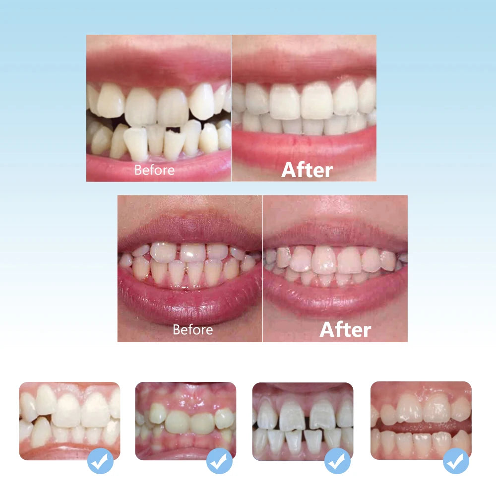 3-Stage Orthodontic Teeth Alignment Trainer Set for Kids