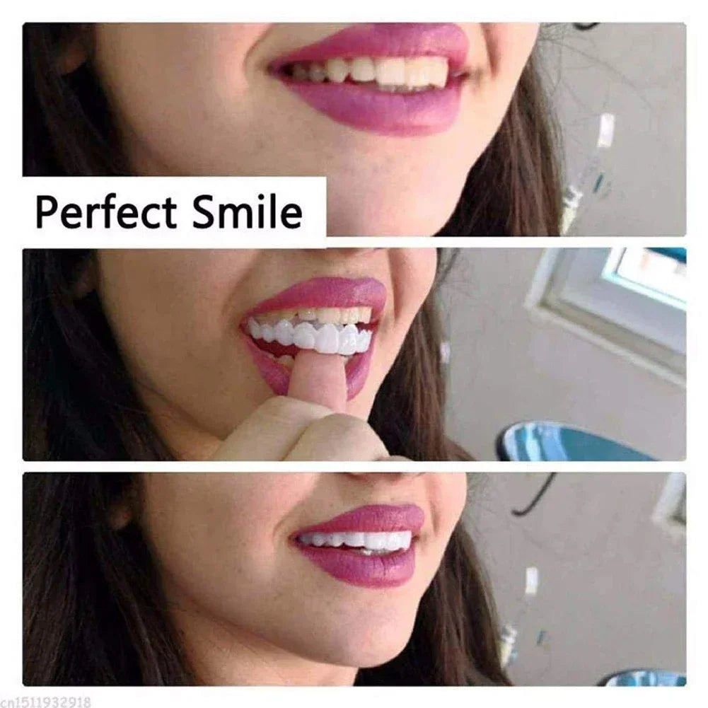 Snap-On Cosmetic Teeth Veneers for Instant Smile Transformation - 2