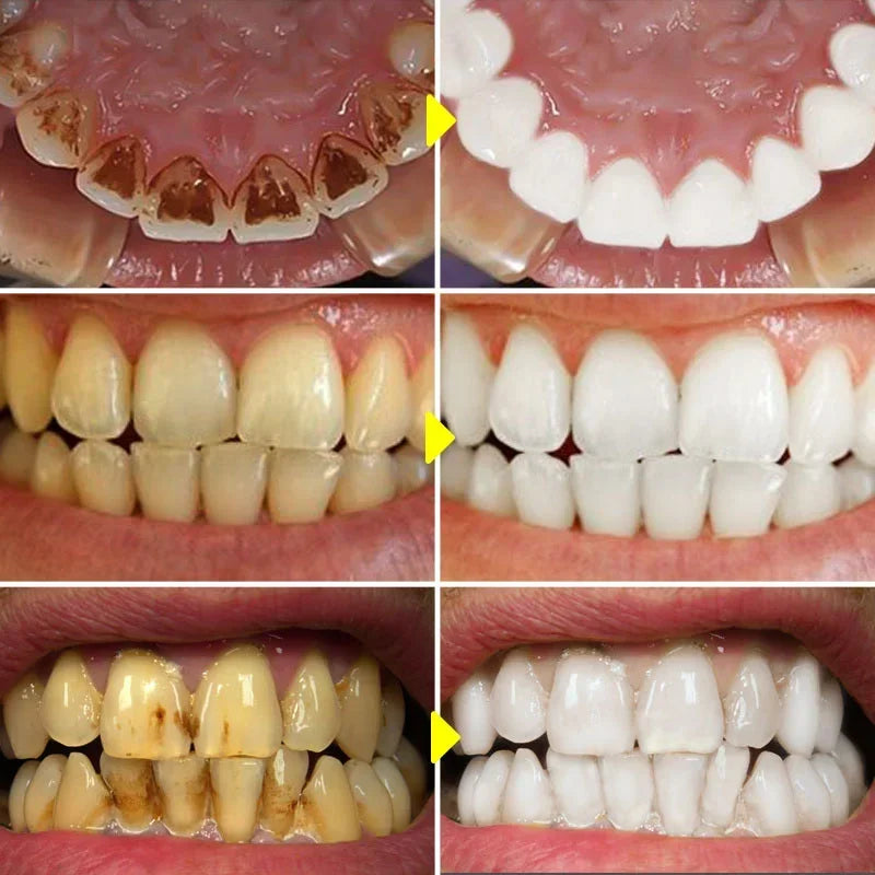 Probiotic Teeth Whitening Toothpaste for Stain Removal and Fresh Breath