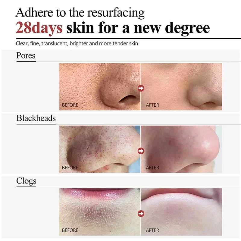 Salicylic Acid Pore Refining Cream for Smooth and Clear Skin