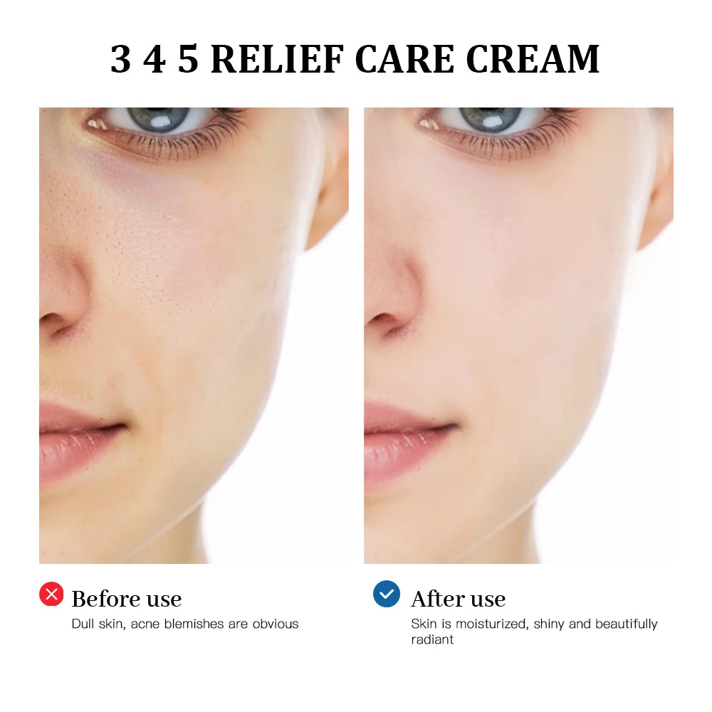 3 4 5 Relief Face Cream for Acne-Prone and Sensitive Skin - 3
