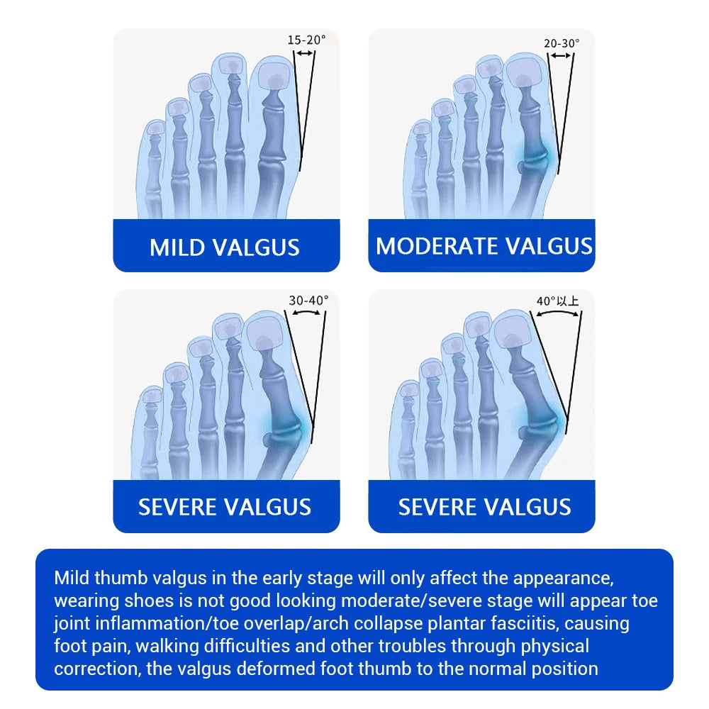 Adjustable Bunion Corrector with Knob Dial for Pain Relief and Alignment