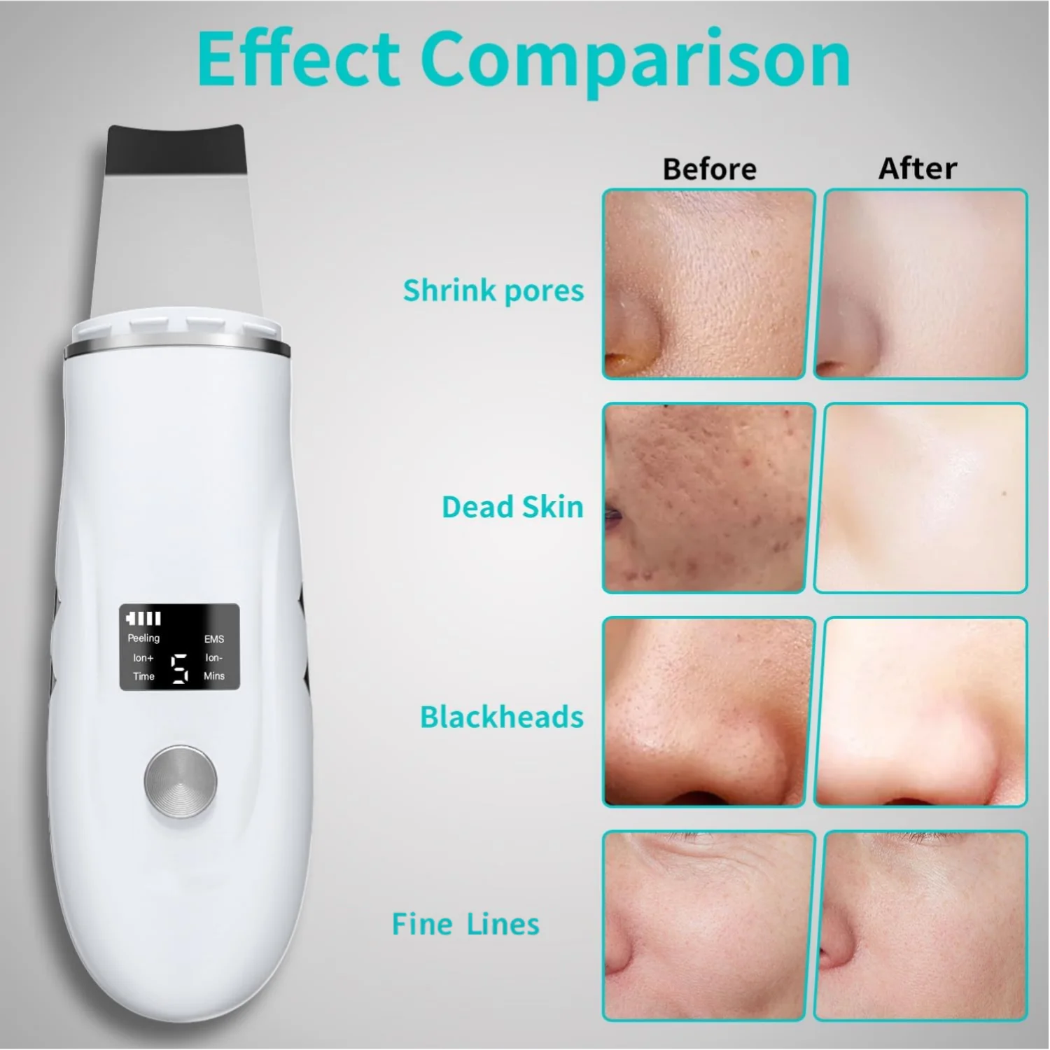 Ultrasonic Facial Skin Scrubber and Pore Cleansing Spatula Device - 3
