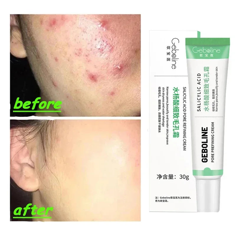 Salicylic Acid Pore Refining Cream for Smooth and Clear Skin