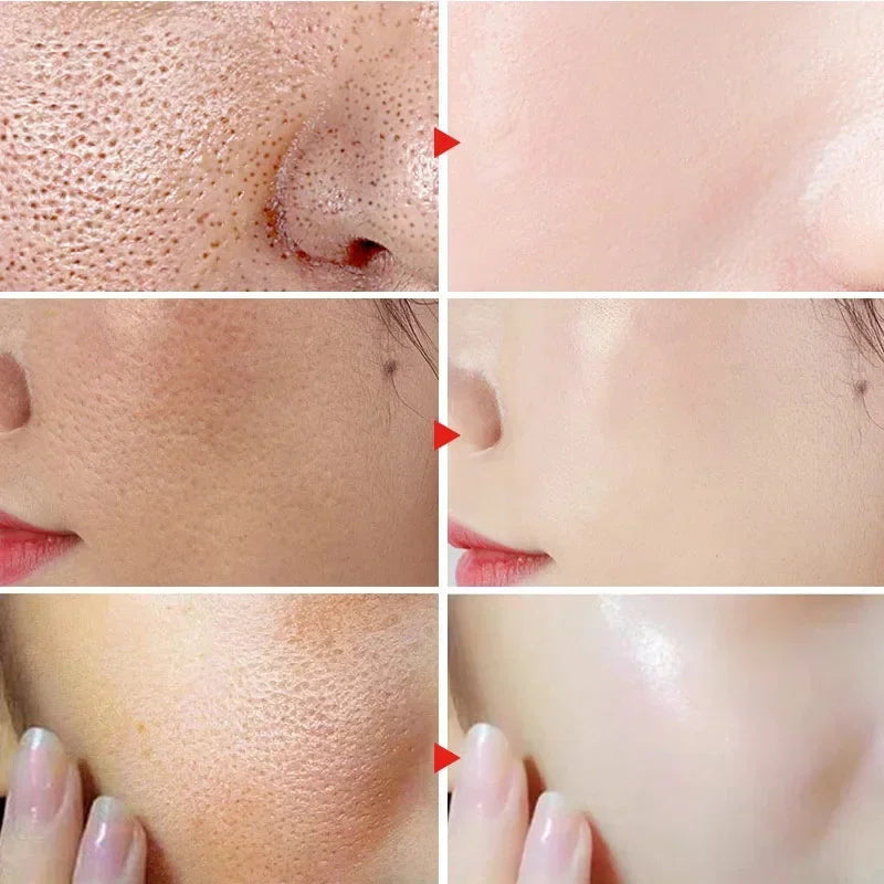 Salicylic Acid Pore Refining Cream for Smooth and Clear Skin