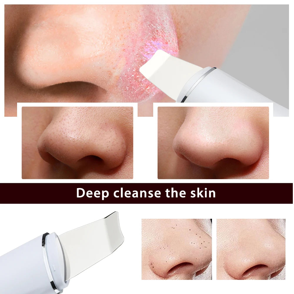Ultrasonic Facial Skin Scrubber and Pore Deep Cleaning Tool for Radiant Skin - 6