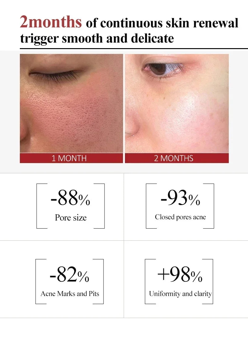 Salicylic Acid Pore Refining Cream for Smooth and Clear Skin