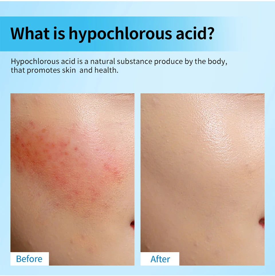 Hypochlorous Acid Facial Spray for Acne Redness and Piercing Aftercare - 10