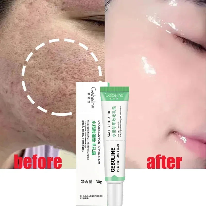 Salicylic Acid Pore Refining Cream for Smooth and Clear Skin
