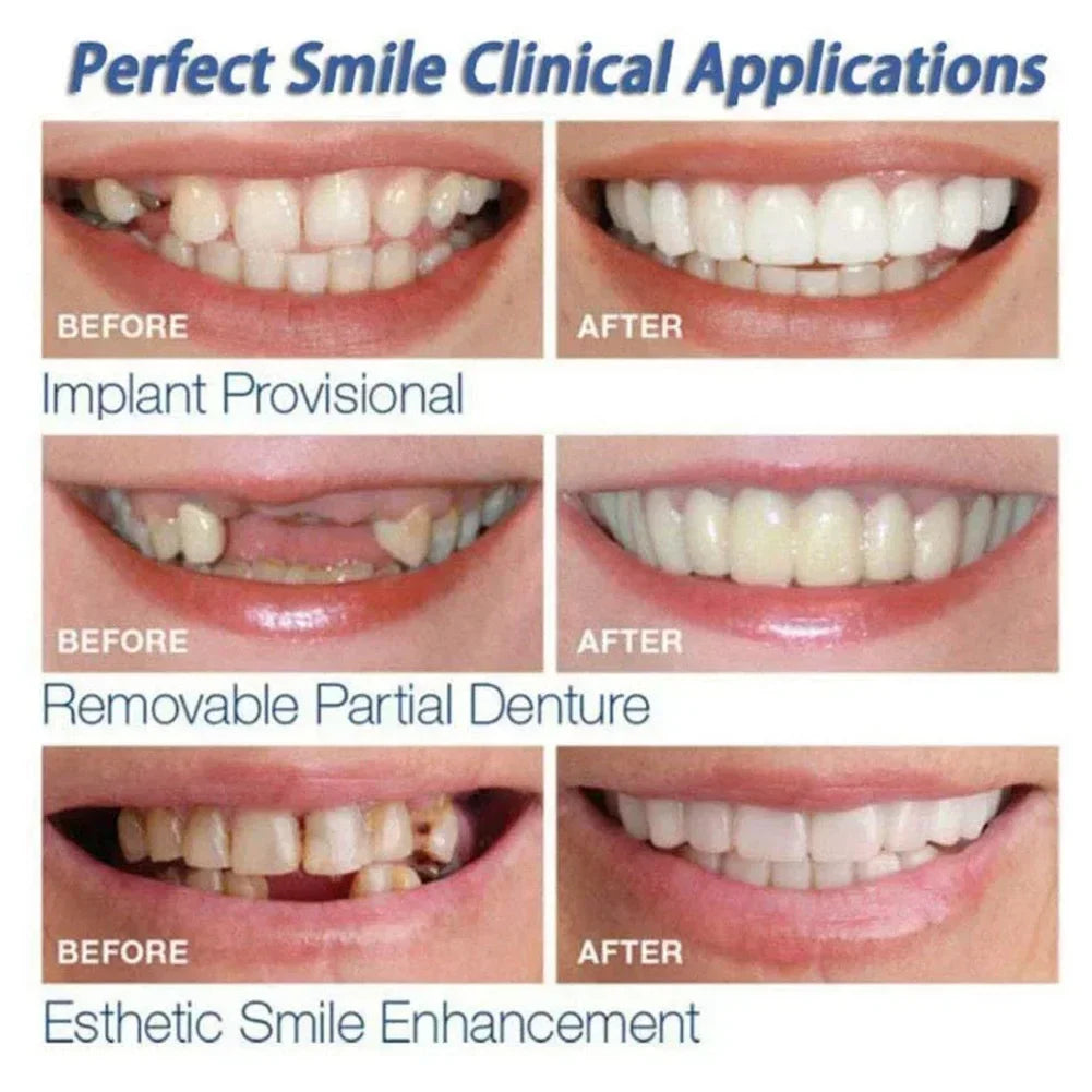 Snap-On Cosmetic Teeth Veneers for Instant Smile Transformation