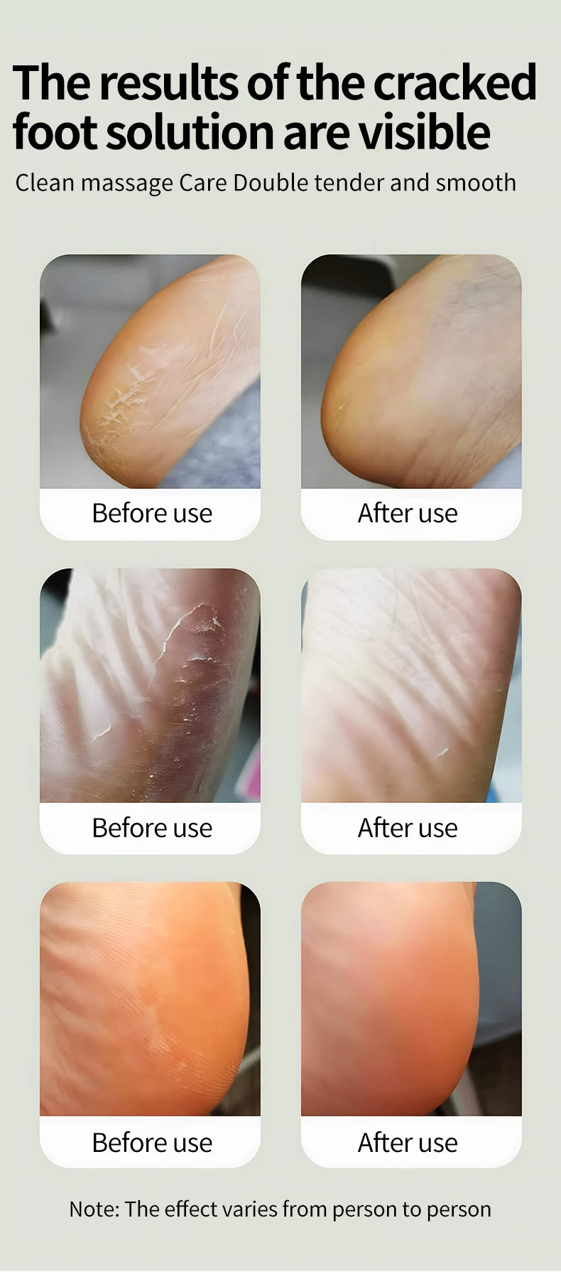 Electric Foot Callus Remover for Smooth Pedicure Results at Home - 10