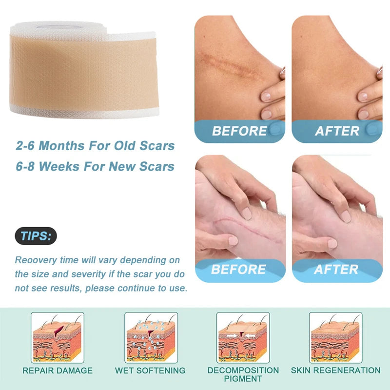 Reusable Silicone Gel Tape for Effective Scar Reduction and Skin Repair