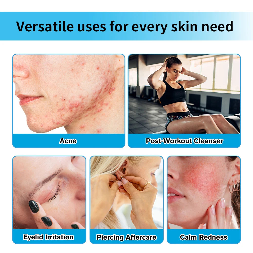 Hypochlorous Acid Facial Spray for Acne Redness and Piercing Aftercare - 2